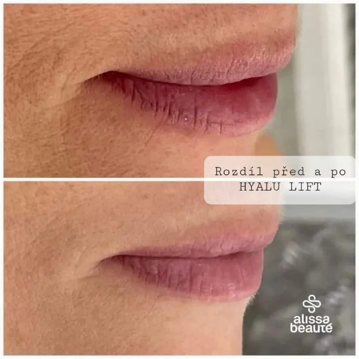 Hyalu Lift Alissa Beauté – rty před a po